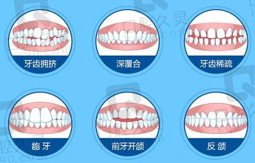 成都新桥口腔金属自锁矫正适应范围