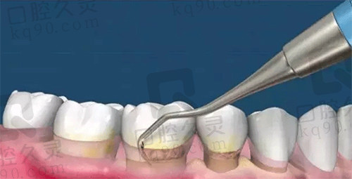 牙周刮治