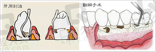 牙周刮治与翻瓣手术