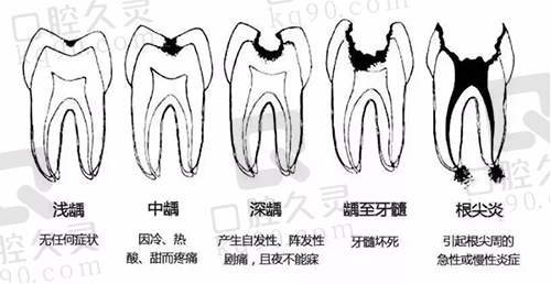 龋齿恶化的示意图