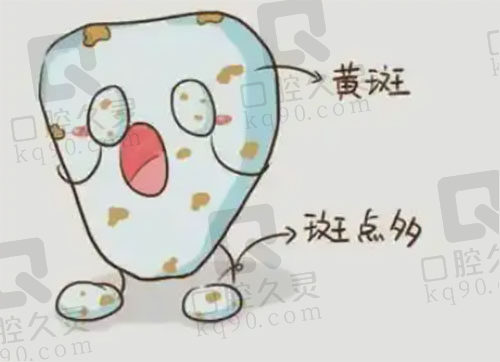 儿童氟斑牙