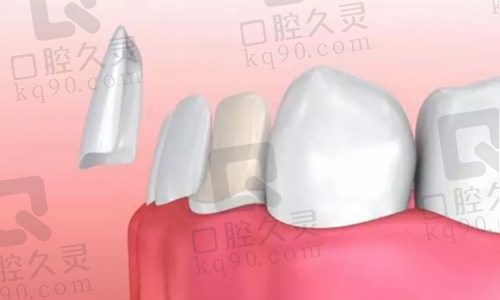 牙贴面修复门牙缺口