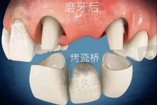 烤瓷桥修复牙齿缺失