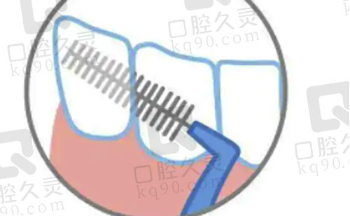医生真的不建议使用牙缝刷吗