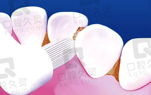 注意牙齿日常清洁