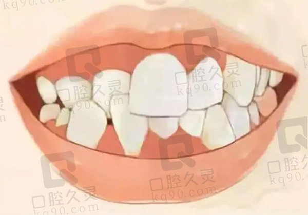 牙齿咬合错位