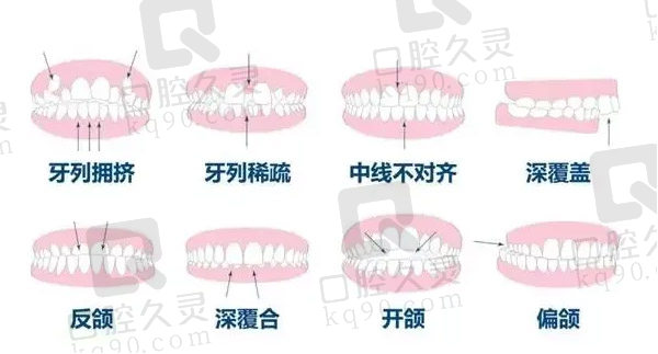 牙齿错位