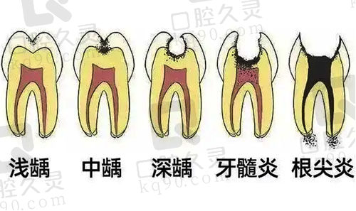 牙周牙髓疾病发展过程示意