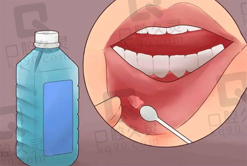 口腔溃疡治疗