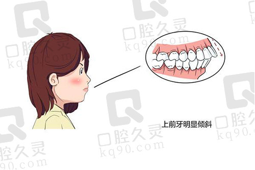 下颌后缩导致下巴短、嘴凸