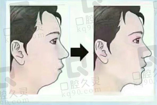 下巴后缩改善前后