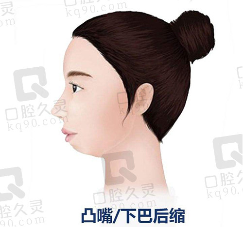 下巴后缩