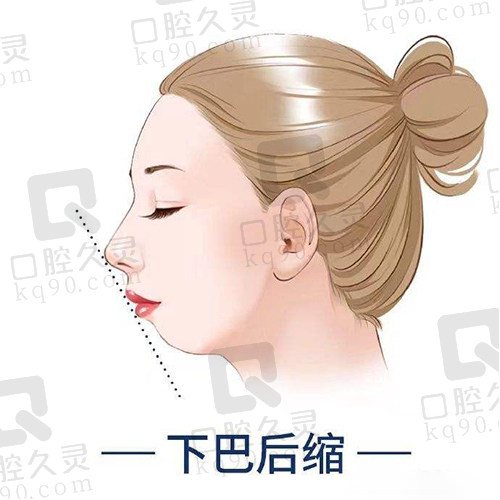 下巴后缩
