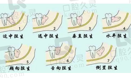 阻生智齿的类型示意图