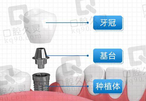 种植牙组成