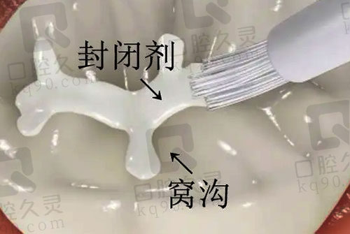 儿童牙齿窝沟封闭