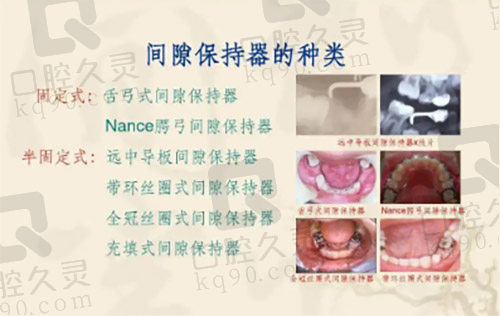 间隙保持器的种类