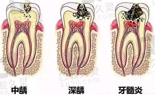 牙髓疾病发展恶化过程图