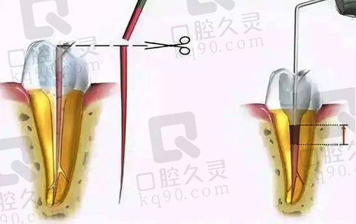 根管填充和预备示范