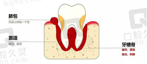 牙龈脓包的原因