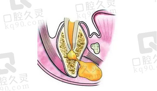 牙龈有脓包的原因