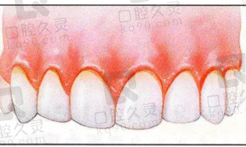 牙龈炎实物图