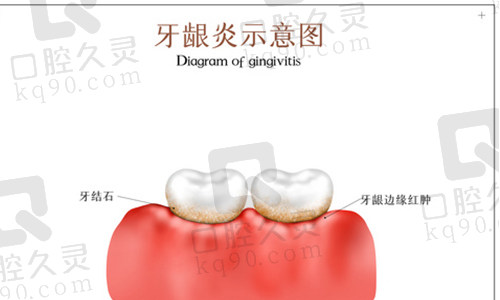 牙龈炎实物图