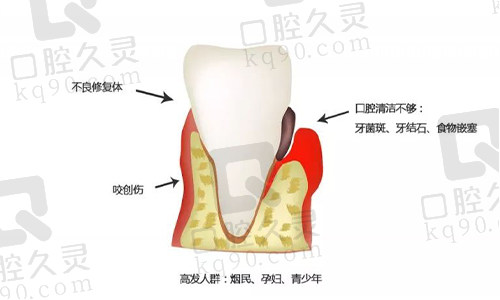 牙龈炎实物图