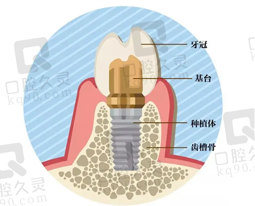 种植牙组成结构