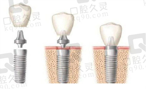 韩国登腾种植体的特点