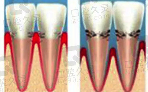 牙周炎导致牙根外露