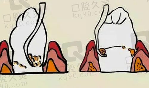 牙根外露治疗要多少钱