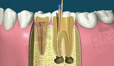 根管治疗