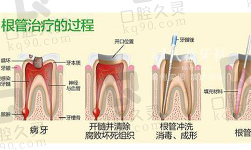 根管治疗