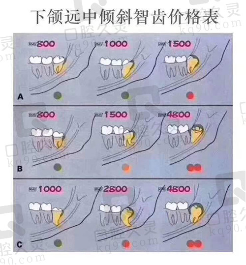 下颌远中倾斜智齿拔除价格表