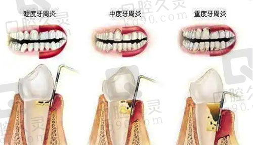 牙周疾病发展过程示范