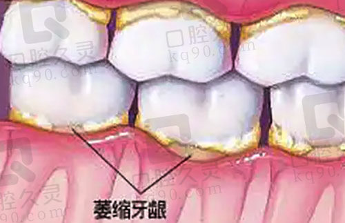 牙龈萎缩如何能恢复