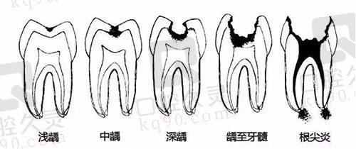 龋齿的发展进程