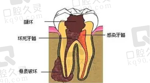 牙髓炎