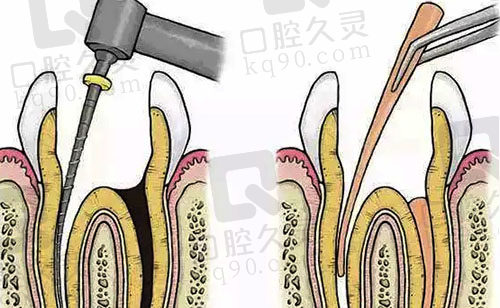 牙齿根管治疗示意图