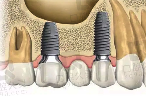 牙齿缺失种植方式