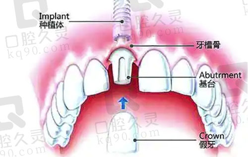 种植牙详细分析
