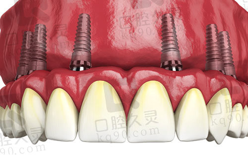 种植牙修复牙齿缺失