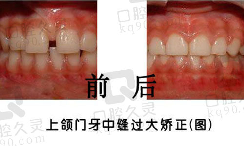牙缝变大图片