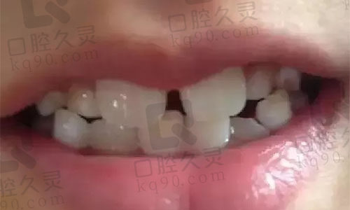 牙缝变大图片