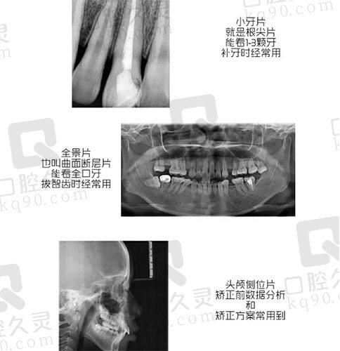 牙片种类