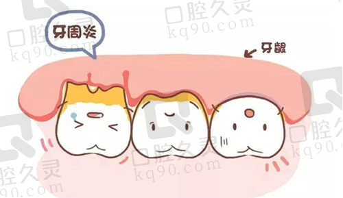 牙周炎