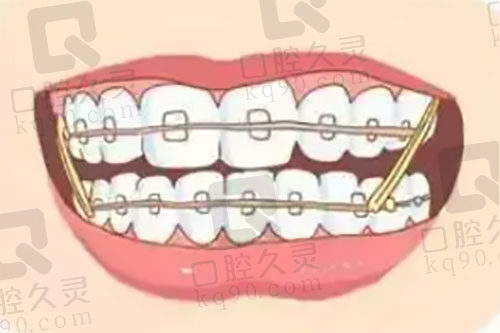 牙齿矫正