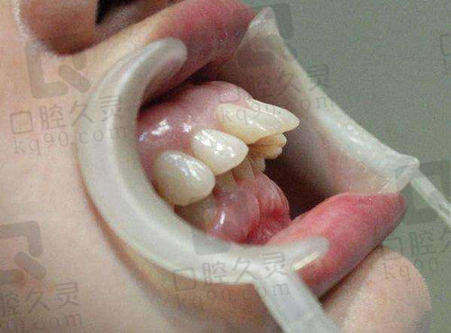 龅牙临床表现