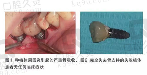 种植体周围炎